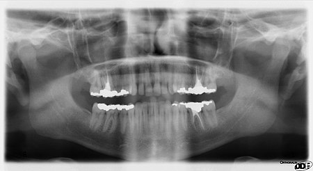 Dental X-Rays: Why Are They Important? An Interview with Dr. Karagiorgos